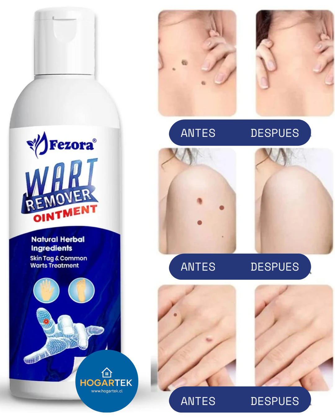 Crema Eliminadora de Verrugas y Fibromas - Tratamiento Efectivo - Resultados visibles en solo 7 días