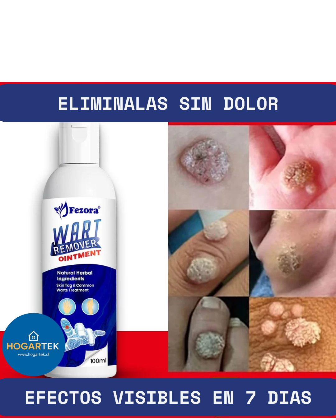 Crema Eliminadora de Verrugas y Fibromas - Tratamiento Efectivo - Resultados visibles en solo 7 días